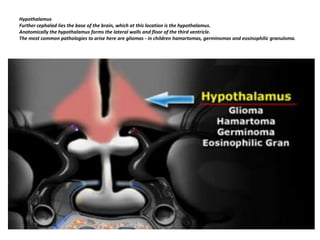 Hypothalamus
Further cephalad lies the base of the brain, which at this location is the hypothalamus.
Anatomically the hypothalamus forms the lateral walls and floor of the third ventricle.
The most common pathologies to arise here are gliomas - in children hamartomas, germinomas and eosinophilic granuloma.

 