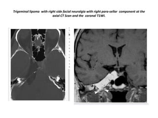 Trigeminal lipoma with right side facial neuralgia with right para-sellar component at the
axial CT Scan and the coronal T1WI.

 