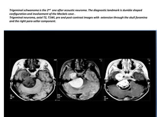 Trigeminal schwanoma is the 2nd one after acoustic neuroma. The diagnostic landmark is dumble shaped
configuration and involvement of the Meckels cave .
Trigeminal neuroma, axial T2, T1WI, pre and post-contrast images with extension through the skull foramina
and the right para-sellar component.

 