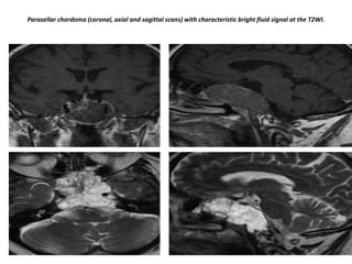 Parasellar chordoma (coronal, axial and sagittal scans) with characteristic bright fluid signal at the T2WI.

 