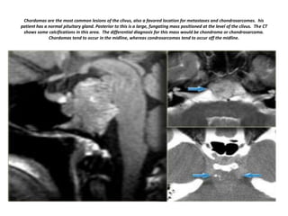 Chordomas are the most common lesions of the clivus, also a favored location for metastases and chondrosarcomas. his
patient has a normal pituitary gland. Posterior to this is a large, fungating mass positioned at the level of the clivus. The CT
shows some calcifications in this area. The differential diagnosis for this mass would be chondroma or chondrosarcoma.
Chordomas tend to occur in the midline, whereas condrosarcomas tend to occur off the midline.

 