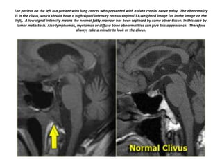 The patient on the left is a patient with lung cancer who presented with a sixth cranial nerve palsy. The abnormality
is in the clivus, which should have a high signal intensity on this sagittal T1-weighted image (as in the image on the
left). A low signal intensity means the normal fatty marrow has been replaced by some other tissue. In this case by
tumor metastasis. Also lymphomas, myelomas or diffuse bone abnormalities can give this appearance. Therefore
always take a minute to look at the clivus.

 