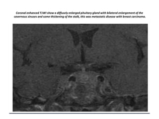 Coronal enhanced T1WI show a diffusely enlarged pituitary gland with bilateral enlargement of the
cavernous sinuses and some thickening of the stalk, this was metastatic disease with breast carcinoma.

 
