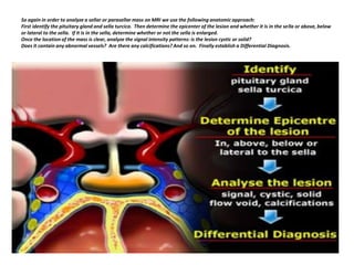 So again in order to analyze a sellar or parasellar mass on MRI we use the following anatomic approach:
First identify the pituitary gland and sella turcica. Then determine the epicenter of the lesion and whether it is in the sella or above, below
or lateral to the sella. If it is in the sella, determine whether or not the sella is enlarged.
Once the location of the mass is clear, analyze the signal intensity patterns: is the lesion cystic or solid?
Does it contain any abnormal vessels? Are there any calcifications? And so on. Finally establish a Differential Diagnosis.

 