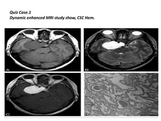 Quiz Case.1
Dynamic enhanced MRI study show, CSC Hem.

 