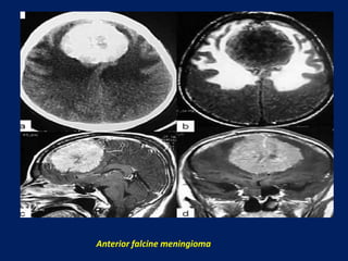 Anterior falcine meningioma

 