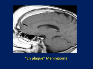 “En plaque” Meningioma

 