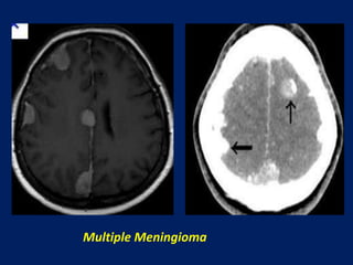 Multiple Meningioma

 