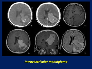 Intraventricular meningioma

 