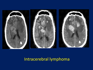 Intracerebral lymphoma

 