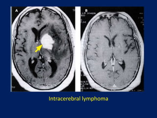 Intracerebral lymphoma

 