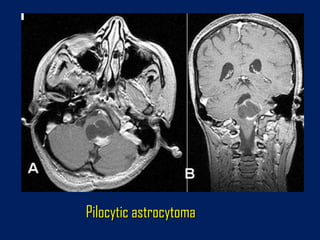 Pilocytic astrocytoma

 