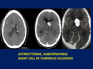 ASTROCYTOMA, SUBEPENDYMAL
GIANT CELL IN TUBEROUS SCLEROSIS

 