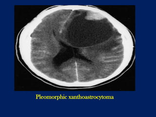Pleomorphic xanthoastrocytoma

 