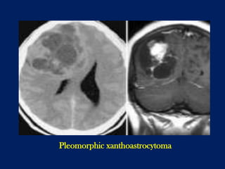 Pleomorphic xanthoastrocytoma

 