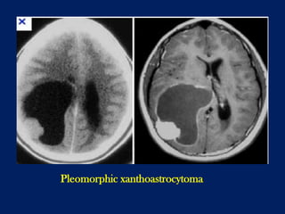 Pleomorphic xanthoastrocytoma

 