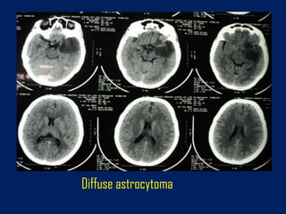 Diffuse astrocytoma

 