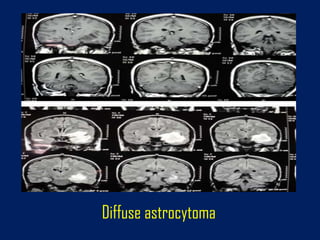 Diffuse astrocytoma

 