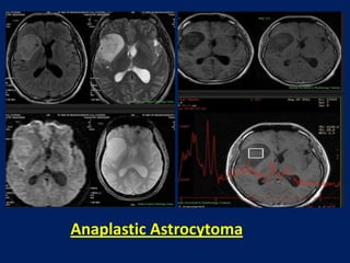 Anaplastic Astrocytoma

 