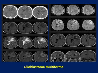 Glioblastoma multiforme

 