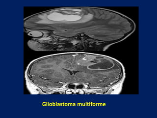 Glioblastoma multiforme

 