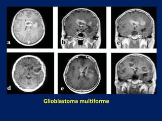 Glioblastoma multiforme

 
