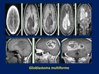 Glioblastoma multiforme

 