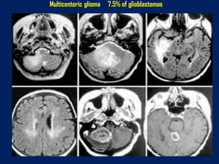 Multicenteric glioma

7.5% of glioblastomas

 