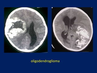 oligodendroglioma

 