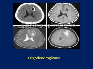Oligodendroglioma

 