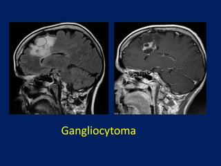 Gangliocytoma

 
