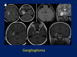 Ganglioglioma

 