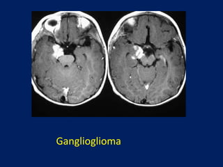 Ganglioglioma

 