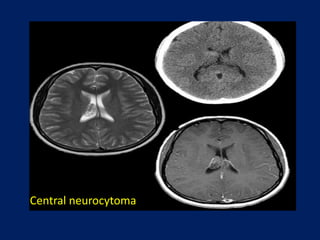 Central neurocytoma

 
