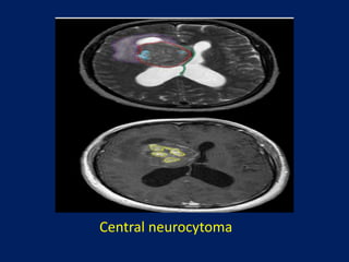 Central neurocytoma

 