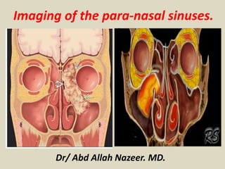 Imaging of the para-nasal sinuses.
Dr/ Abd Allah Nazeer. MD.
 