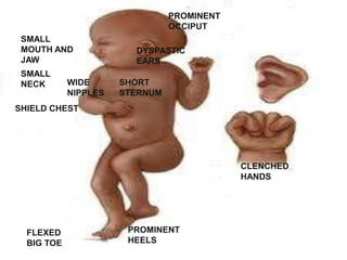 PROMINENT
OCCIPUT
SMALL
MOUTH AND
JAW
SMALL
NECK

WIDE
NIPPLES

DYSPASTIC
EARS
SHORT
STERNUM

SHIELD CHEST

CLENCHED
HANDS

FLEXED
BIG TOE

PROMINENT
HEELS

 