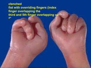 clenched
fist with overriding fingers (index
finger overlapping the
third and 5th finger overlapping the
4th

 