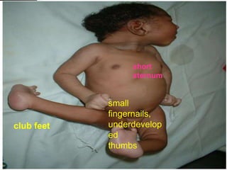 short
sternum

club feet

small
fingernails,
underdevelop
ed
thumbs

 