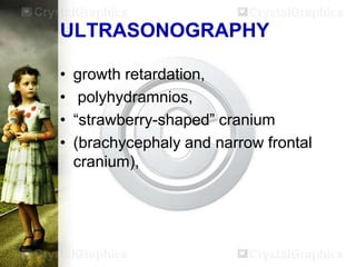 ULTRASONOGRAPHY
•
•
•
•

growth retardation,
polyhydramnios,
“strawberry-shaped” cranium
(brachycephaly and narrow frontal
cranium),

 