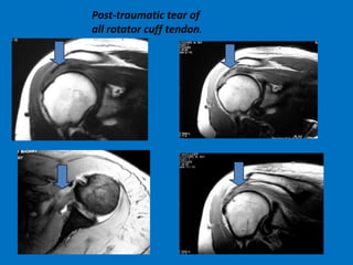 Post-traumatic tear of
all rotator cuff tendon.

 