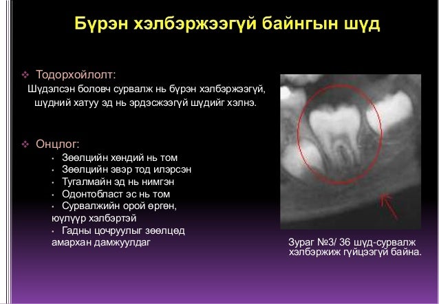 Сүүн болон бүрэн хэлбэржээгүй байнгын шүд