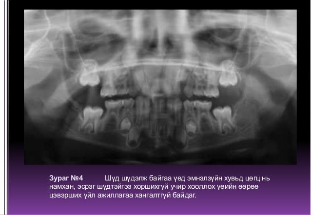 Сүүн болон бүрэн хэлбэржээгүй байнгын шүд