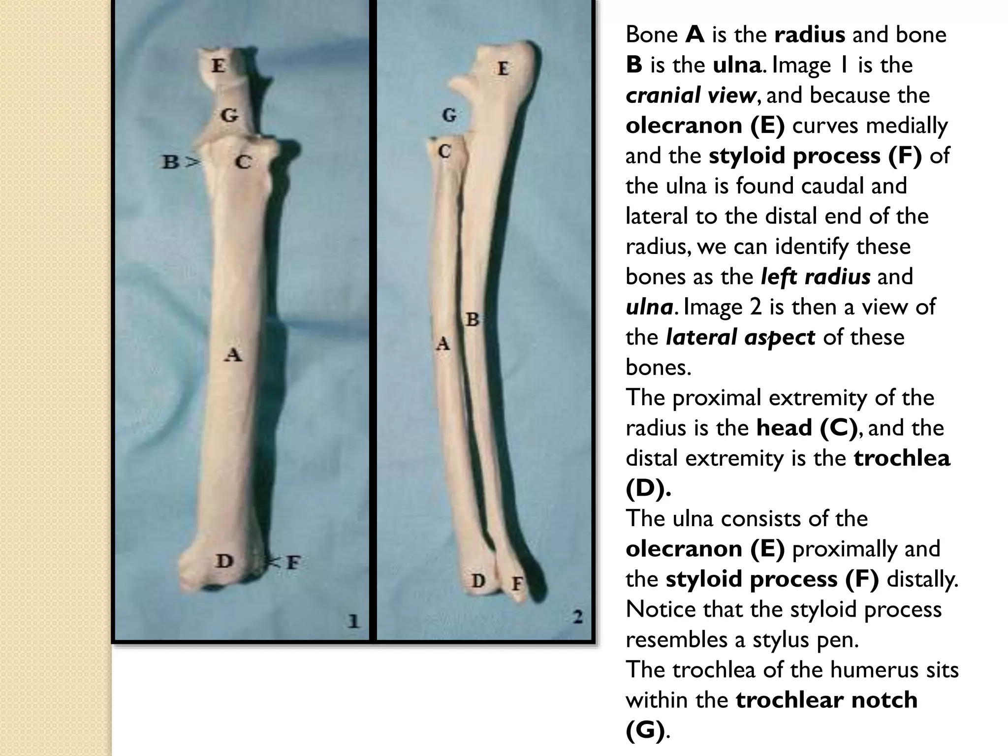 Bone A is the radius and bone
B is the ulna. Image 1 is the
cranial view, and because the
olecranon (E) curves medially
and the styloid process (F) of
the ulna is found caudal and
lateral to the distal end of the
radius, we can identify these
bones as the left radius and
ulna. Image 2 is then a view of
the lateral aspect of these
bones.
The proximal extremity of the
radius is the head (C), and the
distal extremity is the trochlea
(D).
The ulna consists of the
olecranon (E) proximally and
the styloid process (F) distally.
Notice that the styloid process
resembles a stylus pen.
The trochlea of the humerus sits
within the trochlear notch
(G).

 