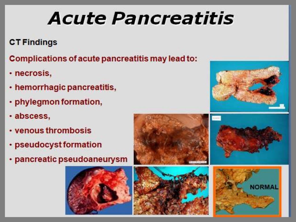 Presentation1.pptx pancreatic disease.