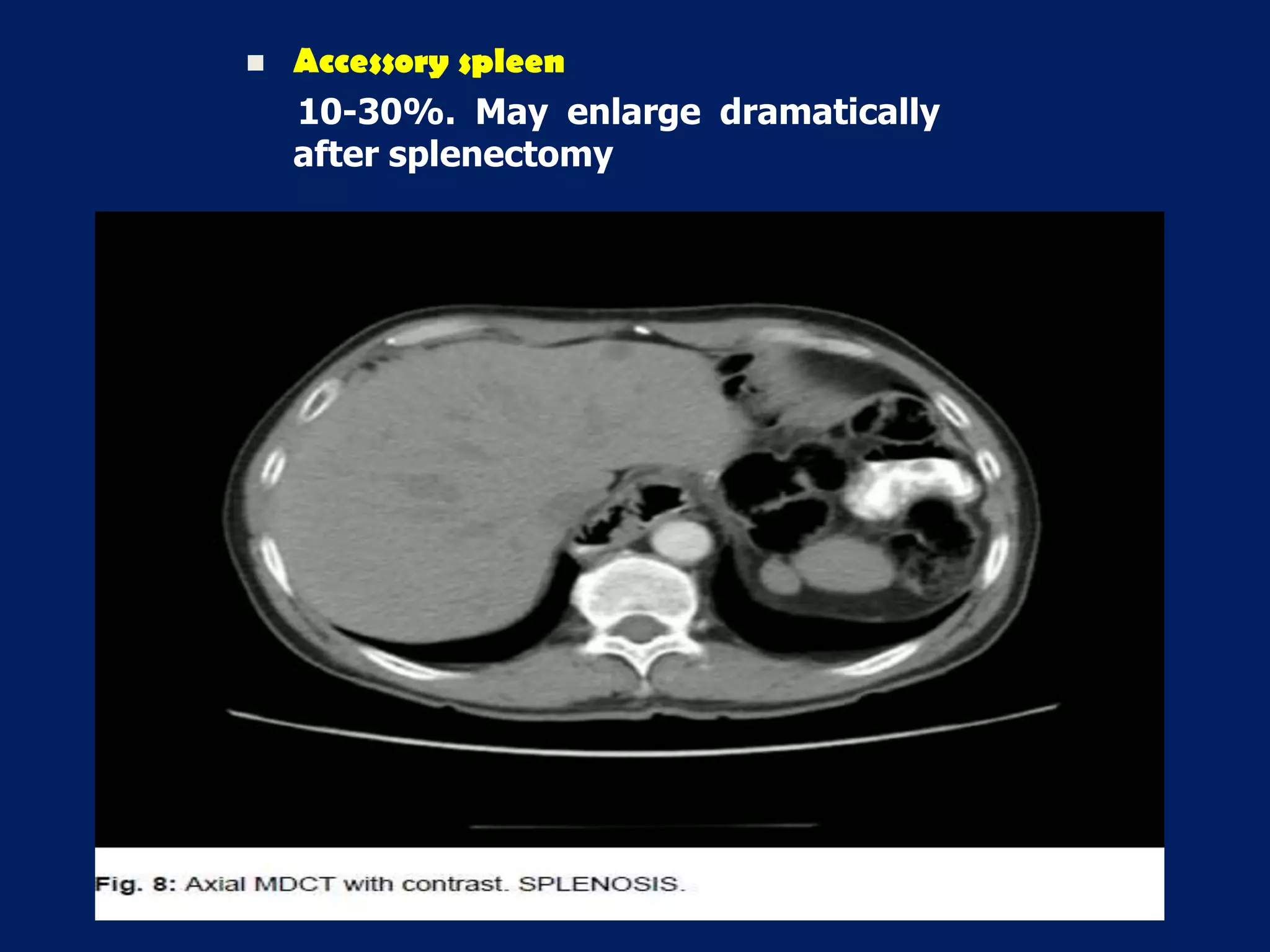  Accessory spleen
10-30%. May enlarge dramatically
after splenectomy