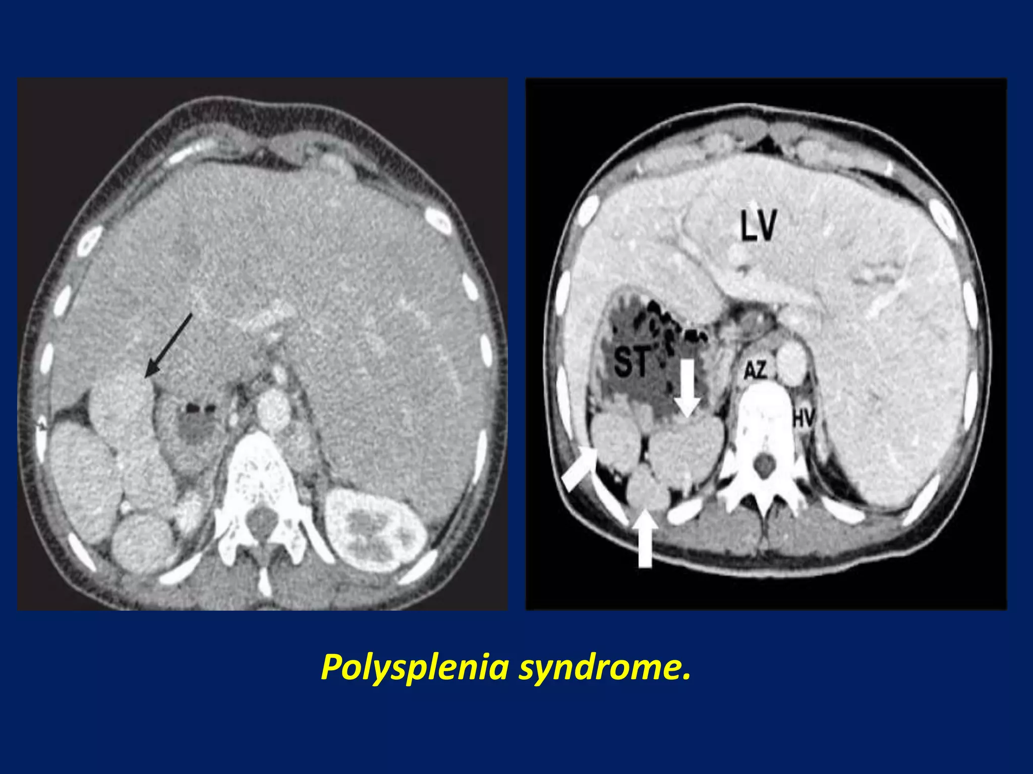 Polysplenia syndrome.