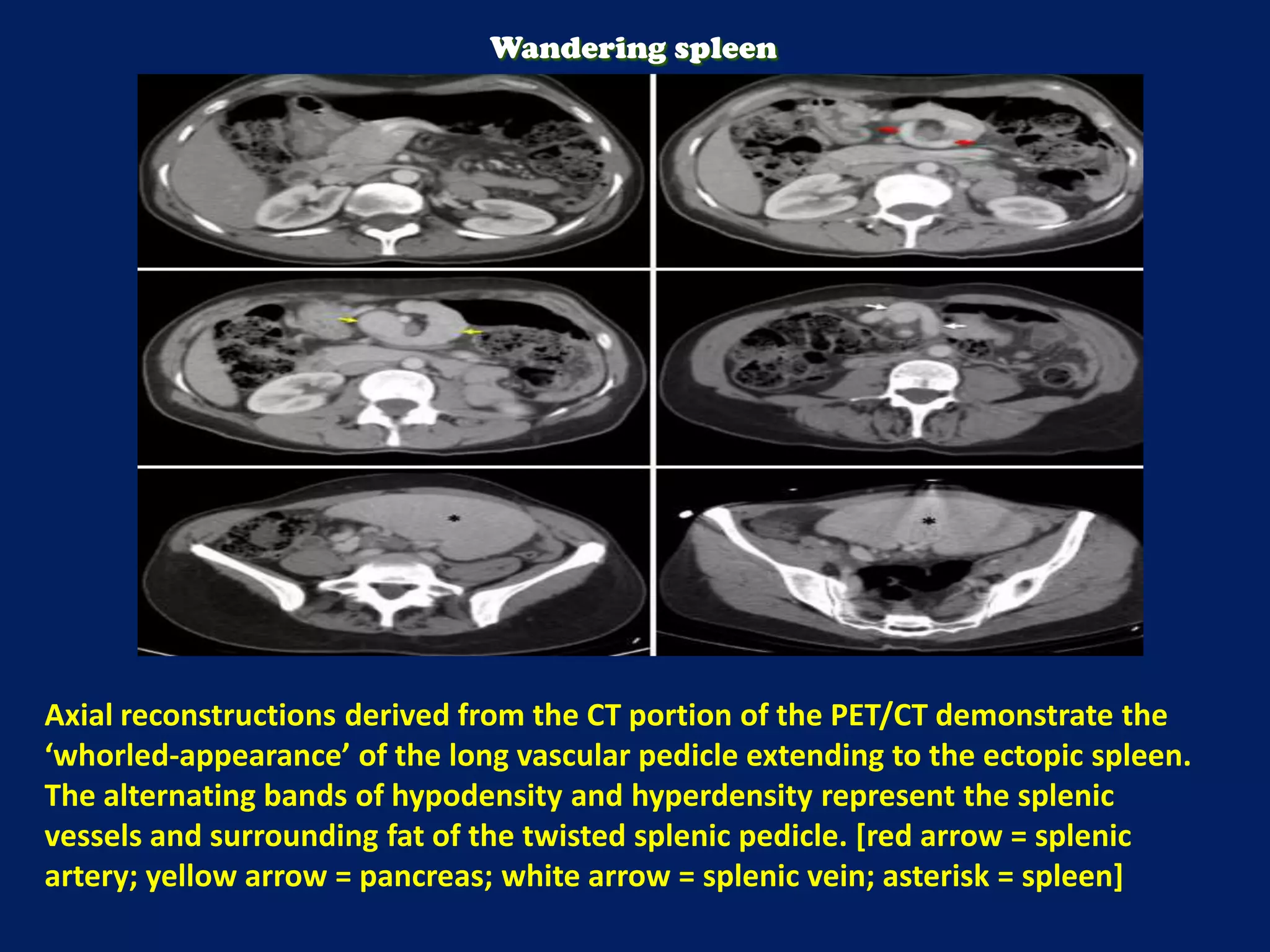 Axial reconstructions derived from the CT portion of the PET/CT demonstrate the
‘whorled-appearance’ of the long vascular pedicle extending to the ectopic spleen.
The alternating bands of hypodensity and hyperdensity represent the splenic
vessels and surrounding fat of the twisted splenic pedicle. [red arrow = splenic
artery; yellow arrow = pancreas; white arrow = splenic vein; asterisk = spleen]
Wandering spleen
 