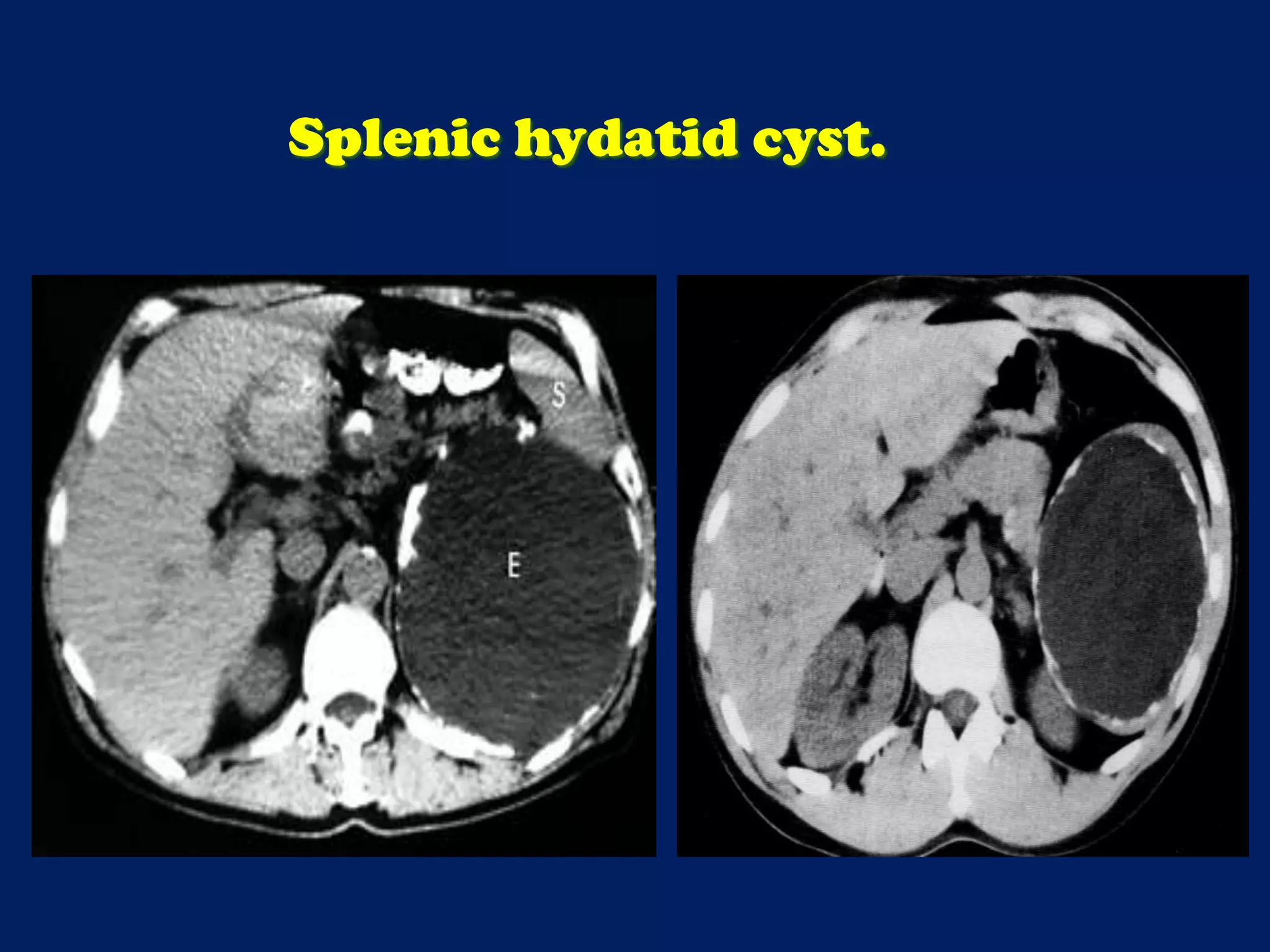 Splenic hydatid cyst.