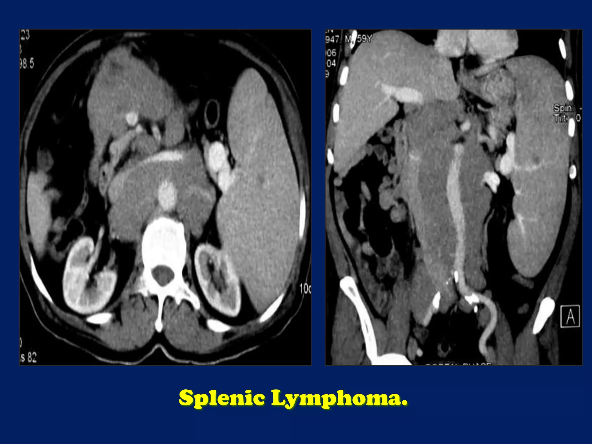 Splenic Lymphoma.